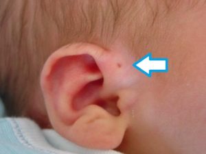 生まれながら耳介の付近に小さな穴ができる状態